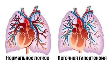 УЗИ сердца ребенку: показания, расшифровка результатов