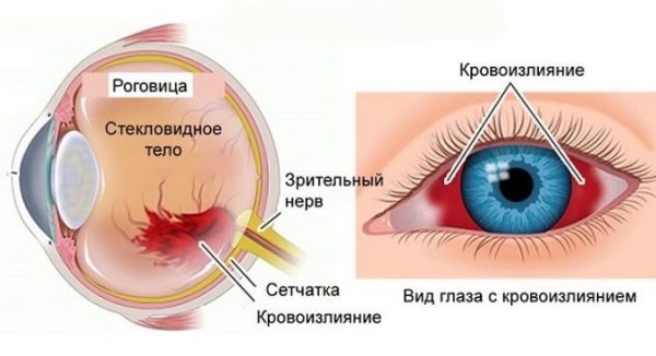 Кровоизлияние в глаз - что капать, какие глазные капли
