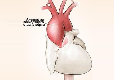 Аневризма аорты восходящего отдела, расширение аорты - лечение. Протезирование аорты в СПб