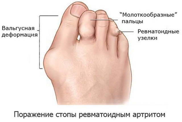 Артрит стопы симптомы и лечение — Суставы