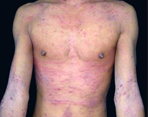 Нейродермит у взрослых и детей: симптомы (фото), лечение