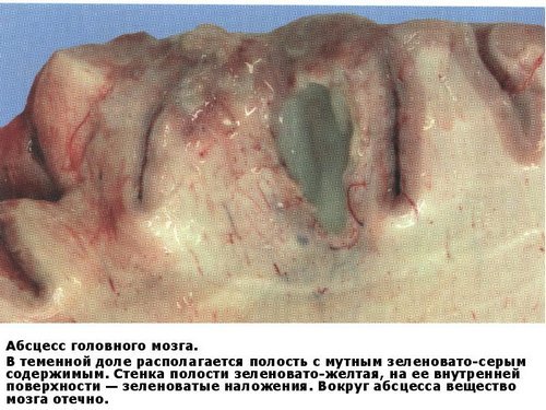 Абсцесс головного мозга - симптомы, лечение, причины, прогноз