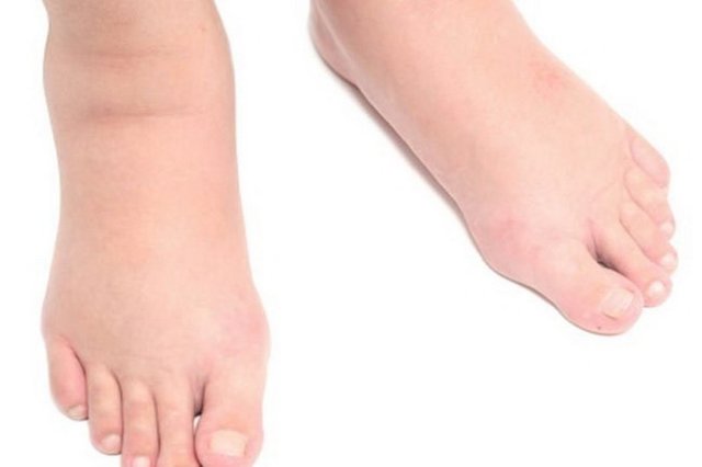 Отеки ног при сердечной недостаточности