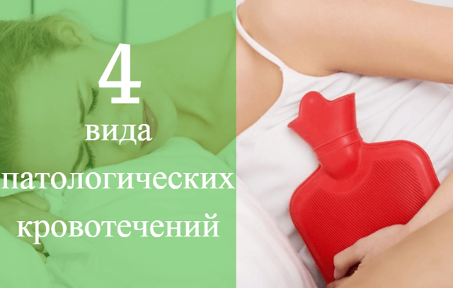 Главные отличия имплантационного кровотечения от месячных