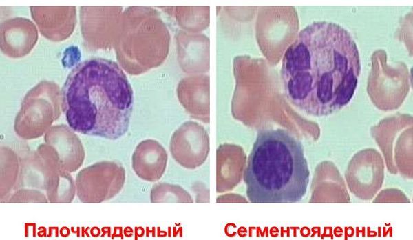Повышены лейкоциты и нейтрофилы в крови у ребенка