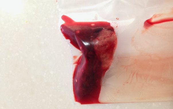 Месячные идут со сгустками крови и кусками — причины