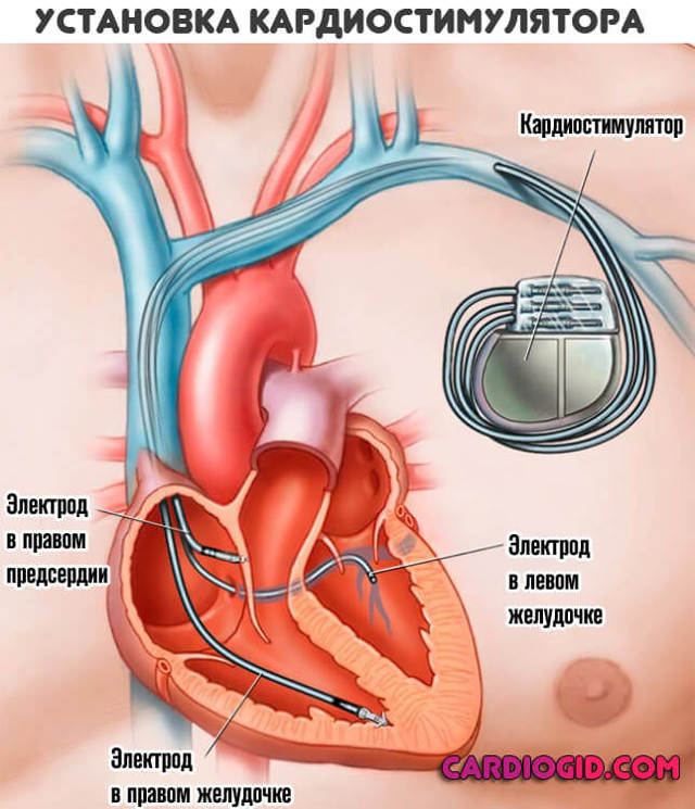 Пульс 95 в покое причины - Все про гипертонию