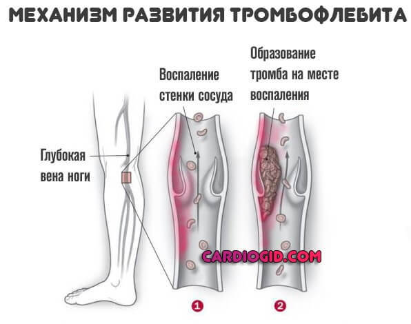 Антикоагулянты – механизм действия, список препаратов