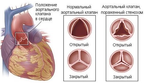 Пульс 100 ударов в минуту в состоянии покоя что делать