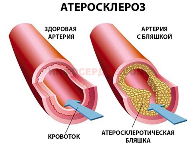 Аорта уплотнена - что это значит? Лечение уплотнения аорты