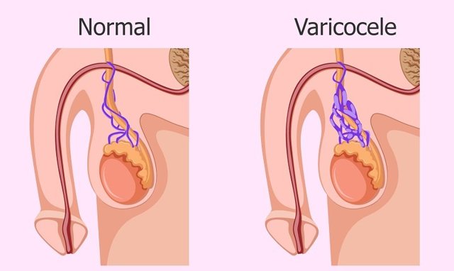 Варикоз на яичках: основные проявления