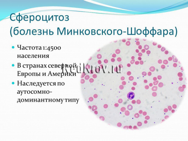 Болезнь Минковского-Шоффара: симптомы, причины возникновения, лечение