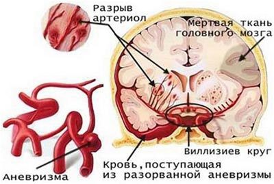 Критические дни после инсульта