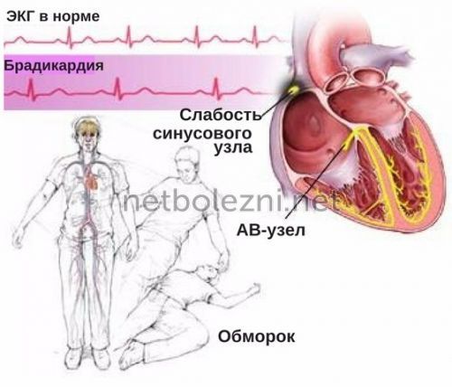 Брадикардия симптомы и лечение, какие таблетки принимать?