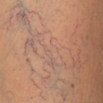 Венотоники при варикозе ног - гель, уколы, отзывы