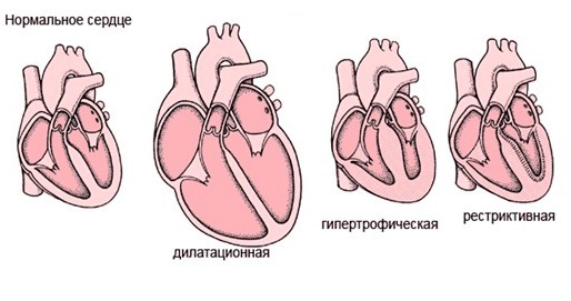 Кардиопатия сердца: симптомы, диагностика и лечение. Что такое кардиопатия у детей? Кардиопатия у детей и взрослых: причины, симптомы, лечение и возможные последствия.