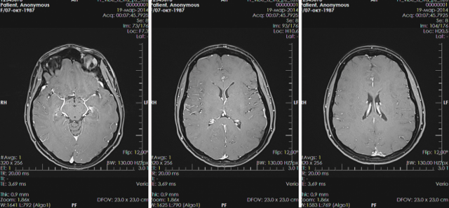 Киста сосудистого сплетения головного мозга: возникновение, диагностика, лечение. Опасна ли киста сосудистого сплетения для новорожденного?