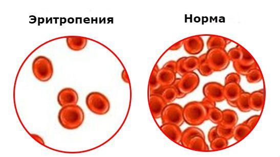 Что значат понижены эритроциты в крови взрослого (причины у женщин). Эритроциты понижены, что это значит