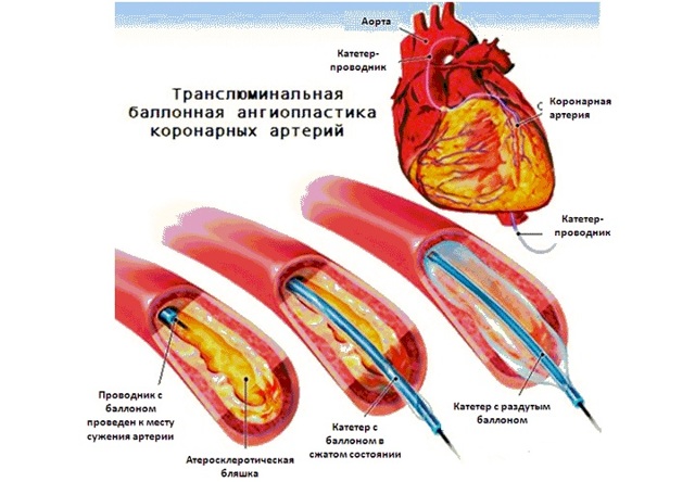 Коронарное стентирование сосудов сердца