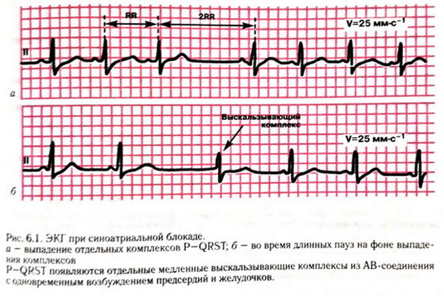 Блокада сердца 1–2 степени — что такое и как лечить?