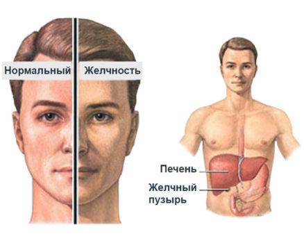 Повышенный билирубин в крови: причины и возможные заболевания