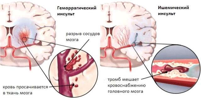 Причины инсульта и как он возникает. Знать всем!