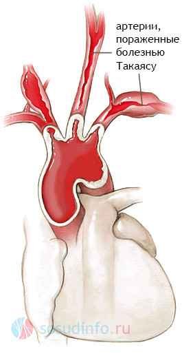 Артериит Такаясу — обследование, диагноз