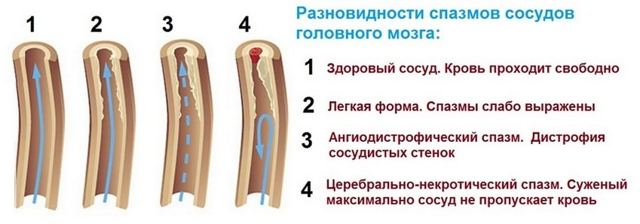 Спазмы сосудов головного мозга: симптомы, лечение, препараты, профилактика