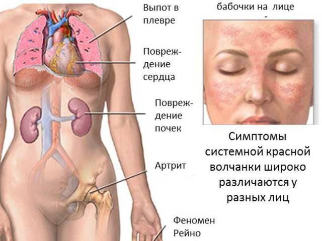 Красная волчанка - что это за болезнь? (с фото)