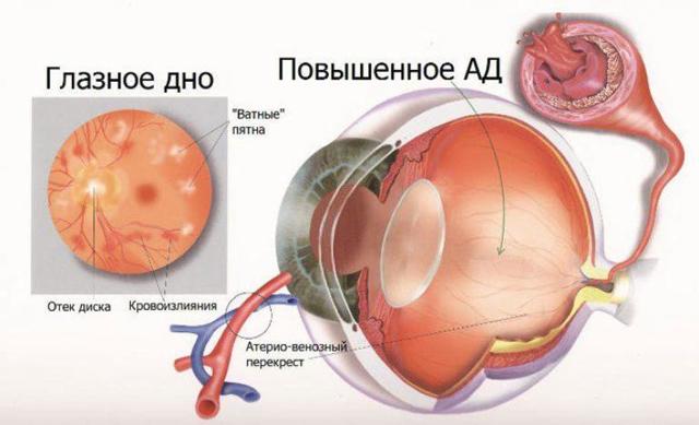 Ангиопатия сетчатки обоих глаз - что это такое и как лечить?