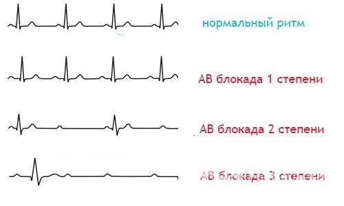 Блокада сердца - что это такое? Причины, симптомы и лечение блокады сердца