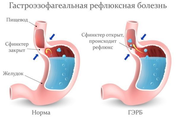 Боль в грудине посередине при вдохе, при нажатии, при движении – причины