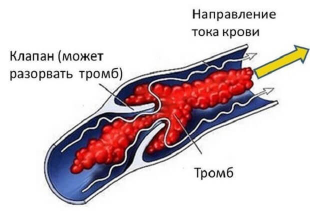 Флебит вены на руке. Лечение постинъекционного флебита после катетера