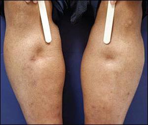 Отеки при сердечной недостаточности: симптомы, патогенез, лечение