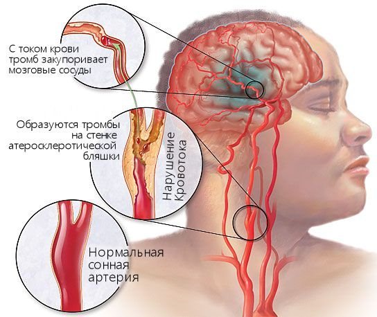 Какой врач лечит сосуды головного мозга, атеросклероз?