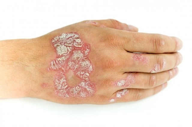 Нейродермит у взрослых и детей: симптомы (фото), лечение