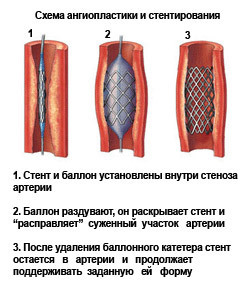 Перемежающаяся хромота - что это такое? - Лечение ног