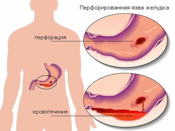 Кровь в желудке: причины и симптомы, диагностика и лечение