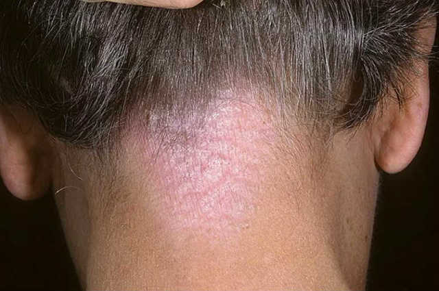 Нейродермит у взрослых и детей: симптомы (фото), лечение