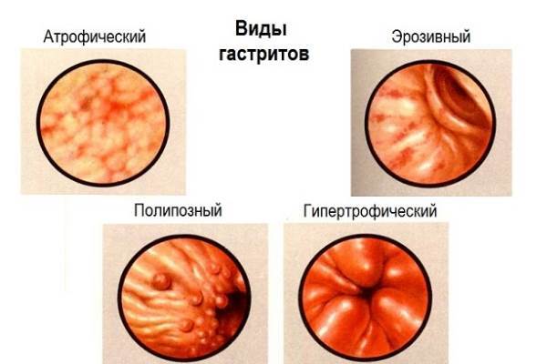 Гипертрофический гастрит - причины, симптомы и лечение