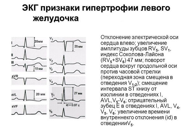 Гипертрофия левого желудочка сердца: признаки на ЭКГ и лечение
