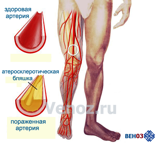 Лечение сосудов: как лечить болезни и заболевания сосудов и вен