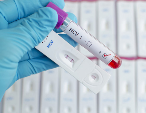 Вирус гепатита С (Hepatitis C Virus), качественное суммарное определение антител, ИФА (anti-HCV, кач.)