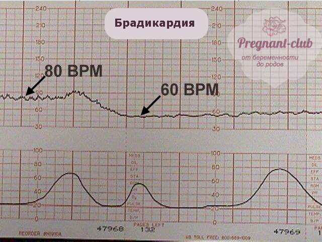 Сердцебиение плода норма ЧСС по неделям