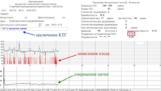 Расшифровка КТГ плода при беременности: как расшифровать, норма, оценка и баллы