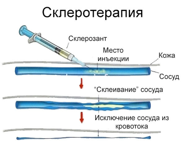 Варикозное расширение вен малого таза у женщин
