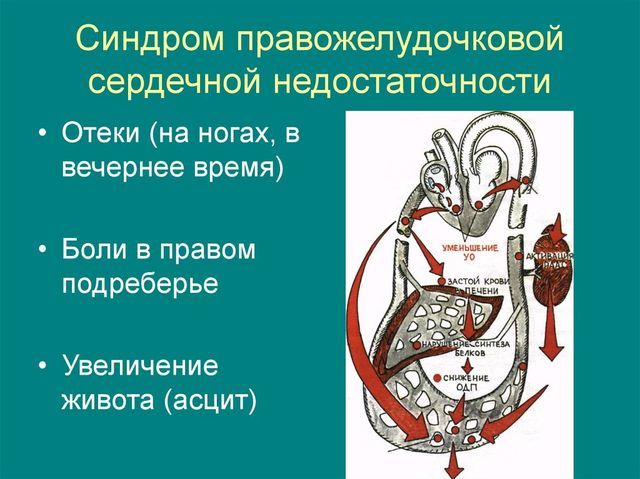 Правожелудочковая недостаточность: причины, симптомы, лечение