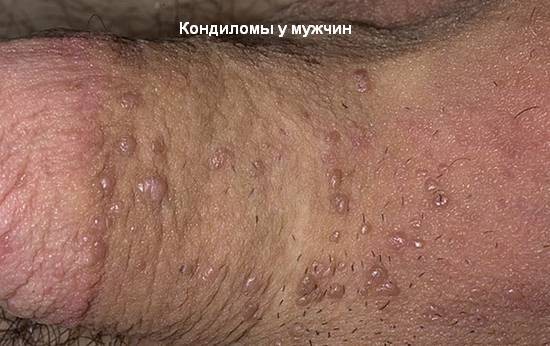 Что такое бородавка и как с ней бороться?