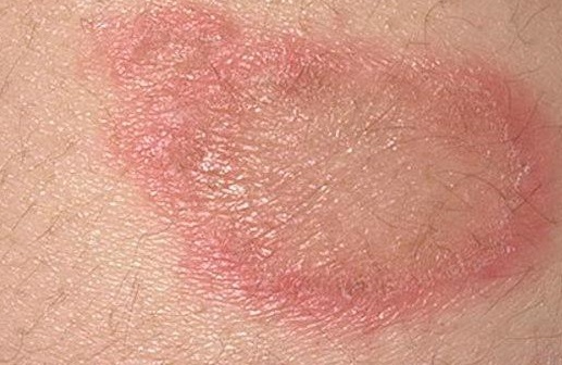 Красные пятна на теле у взрослого - появились красные пятнышки на лице