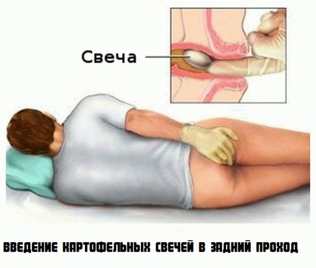 Лечение геморроя в домашних условиях быстро картофелем
